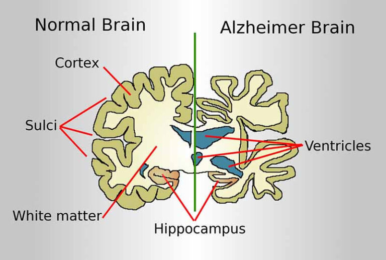 अल्जाइमर रोग क्या है? (What is Alzheimer's Disease in Hindi?)
